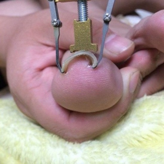 2pcs Pro Paronychia Correction Ingrown Toenail Thick Tool Pedicure Manicure Nail Nipper