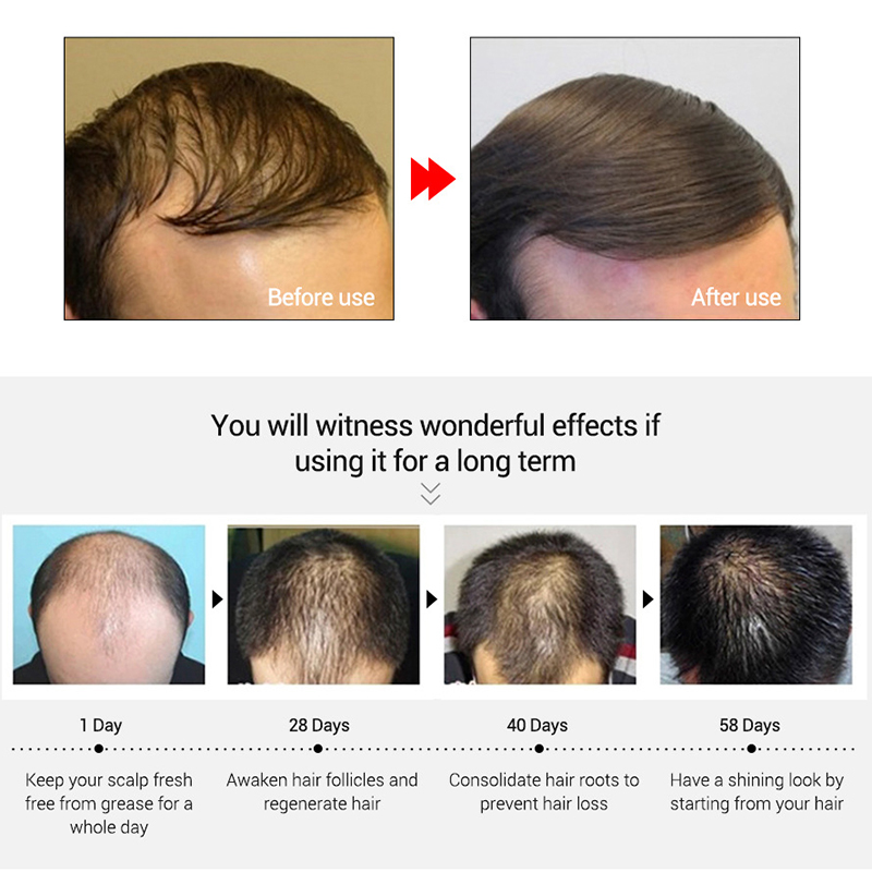 LANBENA-Hair-Growth-Essence-Liquid-Care-Active-Hair-Follicle-Hair-Loss-Treatment-20ml-1287459