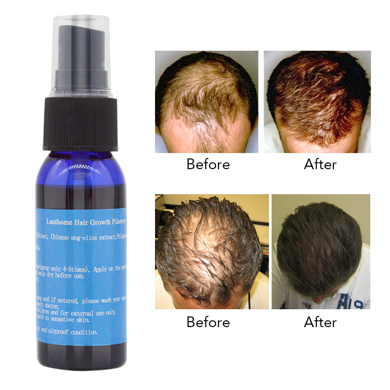 Lanthome-Chinese-Herbal-Fast-Hair-Growth-Essence-Liquid-Anti-Hair-Loss-Treatment-Pilatory-Sprayer-1177179