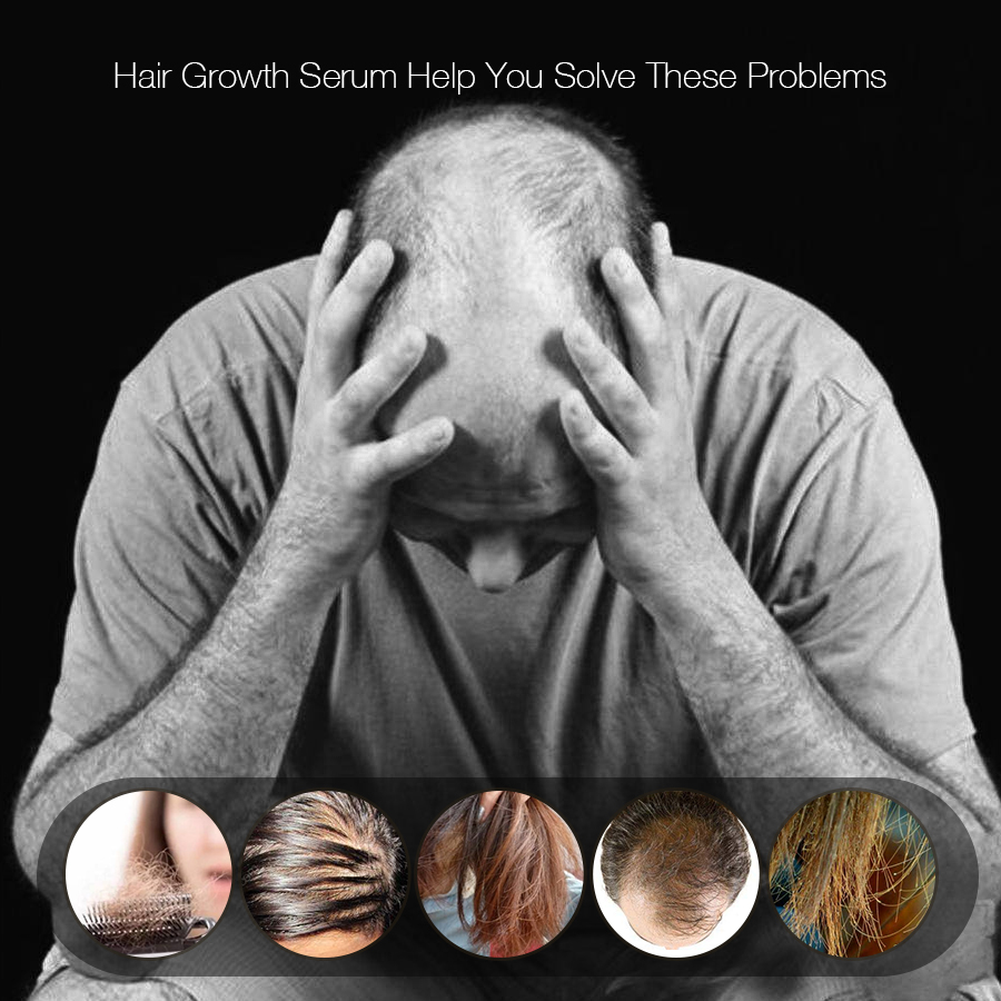 YFMreg-Pure-Herbal-Fast-Hair-Growth-Serum-Essence-Active-Hair-Follicle-Hair-Loss-Treatment-1253437