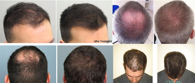 128-Diodes-Laser-Hair-Growth-System-Hair-Regrowth-Helmet-Follicles-Therapy-LLLT-Hair-Loss-Treatment-1383418