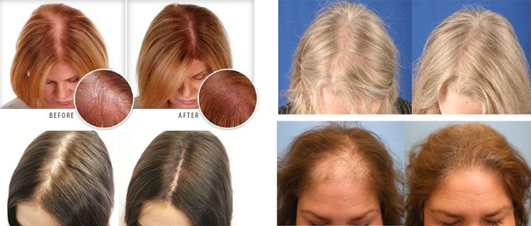 128-Diodes-Laser-Hair-Growth-System-Hair-Regrowth-Helmet-Follicles-Therapy-LLLT-Hair-Loss-Treatment-1383418